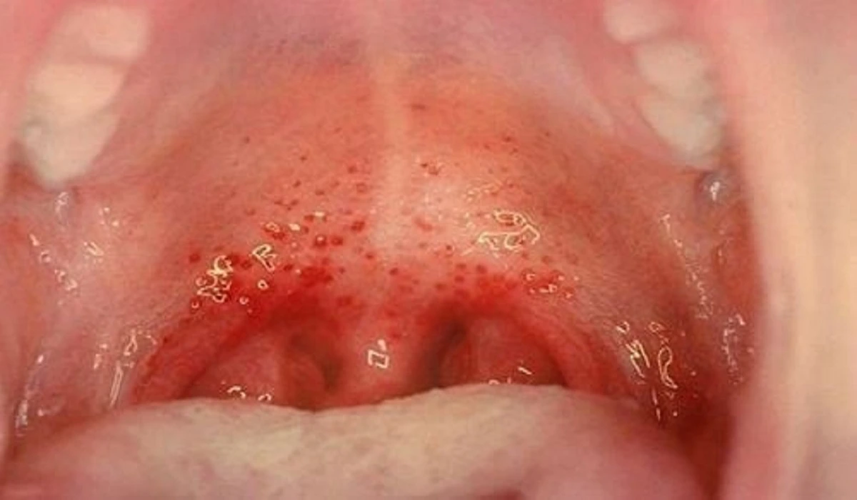 Vệ sinh khoang miệng đúng cách ngăn ngừa vi khuẩn Streptococcus viridans