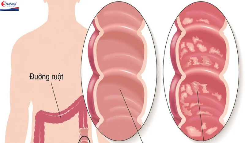 Viêm ruột cấp tính là bệnh phổ biến nhất do Campylobacter jejuni gây ra