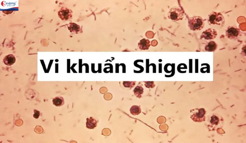 Shigella gây viêm đại tràng, dẫn đến tổn thương lớp niêm mạc của đại tràng